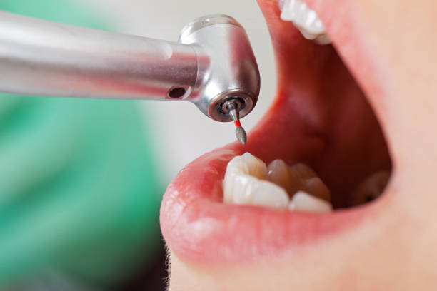 Best Emergency Root Canal Treatment in Muncie, IN
